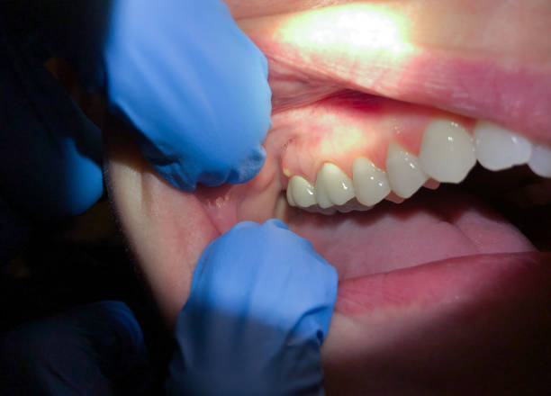 Best Emergency Treatment for Toothache in Bluefield, WV